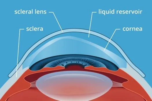 Keratoconus treatment options